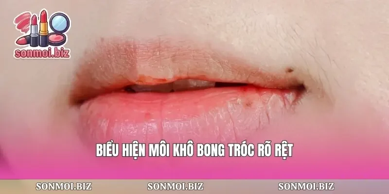 Biểu hiện môi khô bong tróc rõ rệt