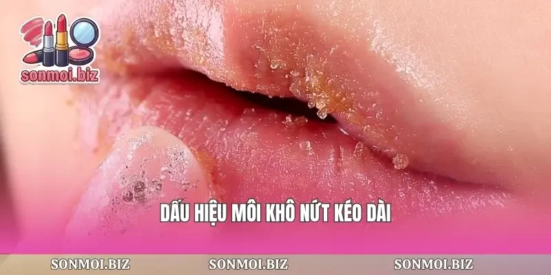 Dấu hiệu môi khô nứt kéo dài