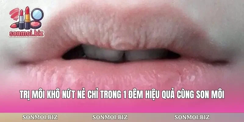 Trị Môi Khô Nứt Nẻ Chỉ Trong 1 Đêm