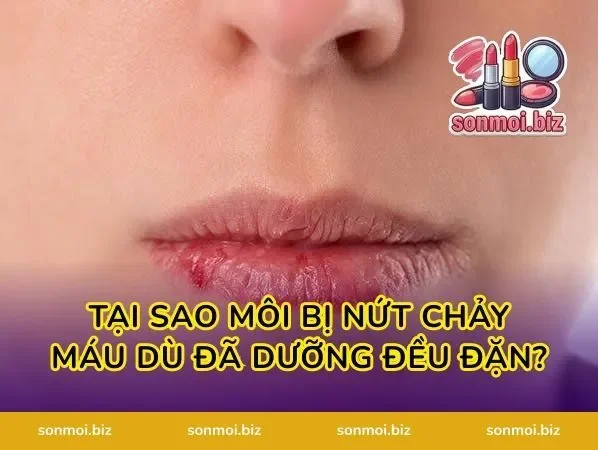 Tại Sao Môi Bị Nứt Chảy Máu Dù Đã Dưỡng Đều Đặn?